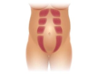 Diastasis Recti Abdominal Separation